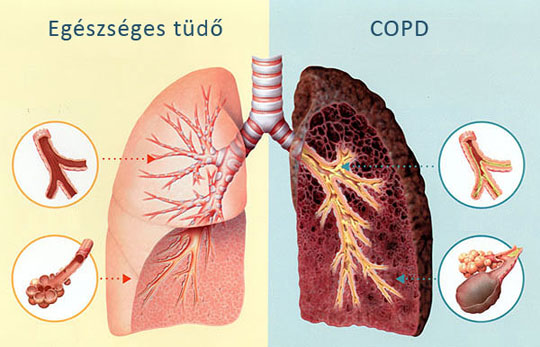 Tüdőgyógyászat - Valeomed Egészségközpont Esztergom