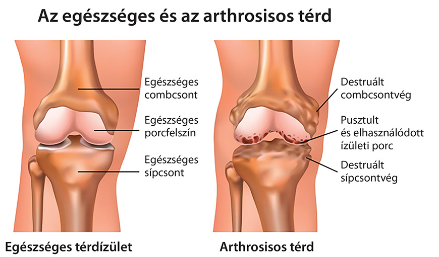 arthrosis típusú kezelések